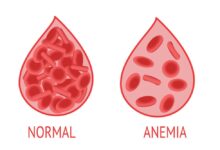 Terungkap! 30% Remaja Putri Cirebon Alami Anemia, Ini Pemicunya