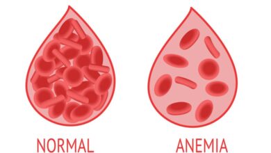 Terungkap! 30% Remaja Putri Cirebon Alami Anemia, Ini Pemicunya