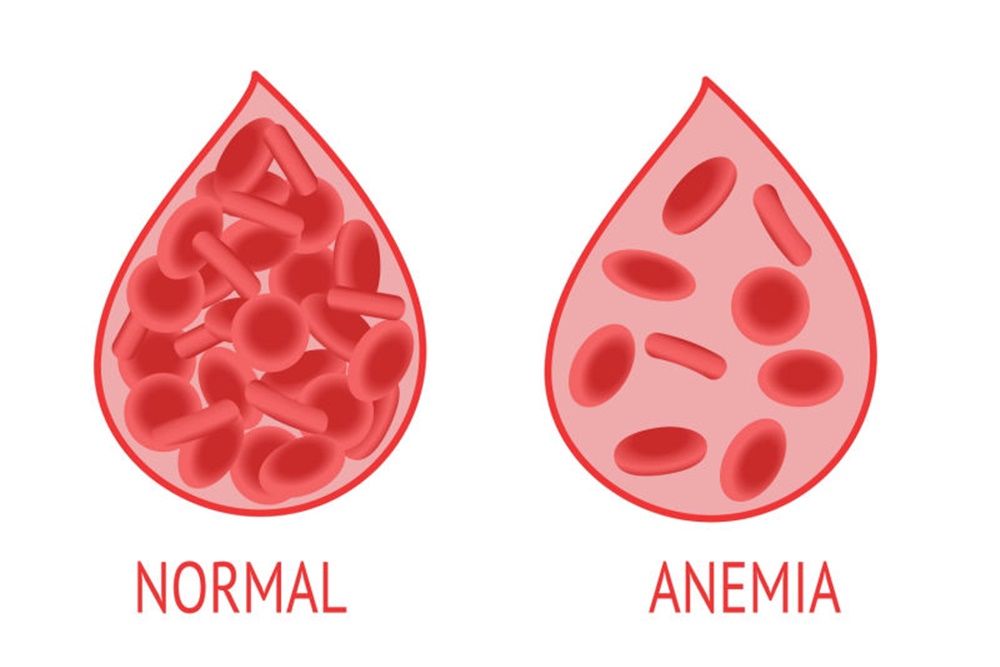 Terungkap! 30% Remaja Putri Cirebon Alami Anemia, Ini Pemicunya