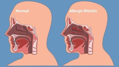 Apa Itu Rhinitis? Temukan Definisi dan Penyebabnya di Sini!