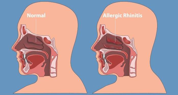 Apa Itu Rhinitis? Temukan Definisi dan Penyebabnya di Sini!