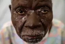 Sierra Leone Darurat Mpox: 1.140 Kasus & 9 Kematian Mengerikan!