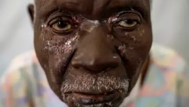 Sierra Leone Darurat Mpox: 1.140 Kasus & 9 Kematian Mengerikan!