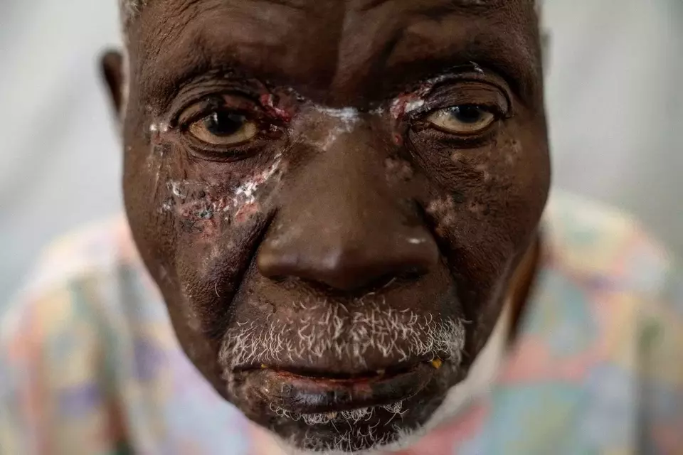 Sierra Leone Darurat Mpox: 1.140 Kasus & 9 Kematian Mengerikan!